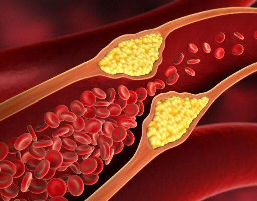 🧨এলডিএল কোলেস্টেরল খারাপ কোলেস্টেরলঃ হার্টের হিটম্যান! কোলেস্টেরলের খলনায়ক 😱 এলডিএল কোলেস্টেরল খারাপ কোলেস্টেরল