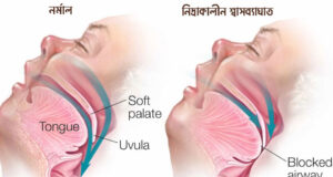 নিদ্রাকালীন শ্বাসব্যাঘাত বা স্লিপ অ্যাপনিয়া যেভাবে মৃত্যুর কারণ হতে পারে নিদ্রাকালীন শ্বাসব্যাঘাত
