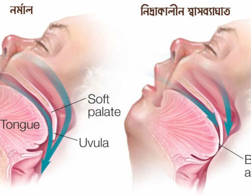 নিদ্রাকালীন শ্বাসব্যাঘাত বা স্লিপ অ্যাপনিয়া যেভাবে মৃত্যুর কারণ হতে পারে নিদ্রাকালীন শ্বাসব্যাঘাত